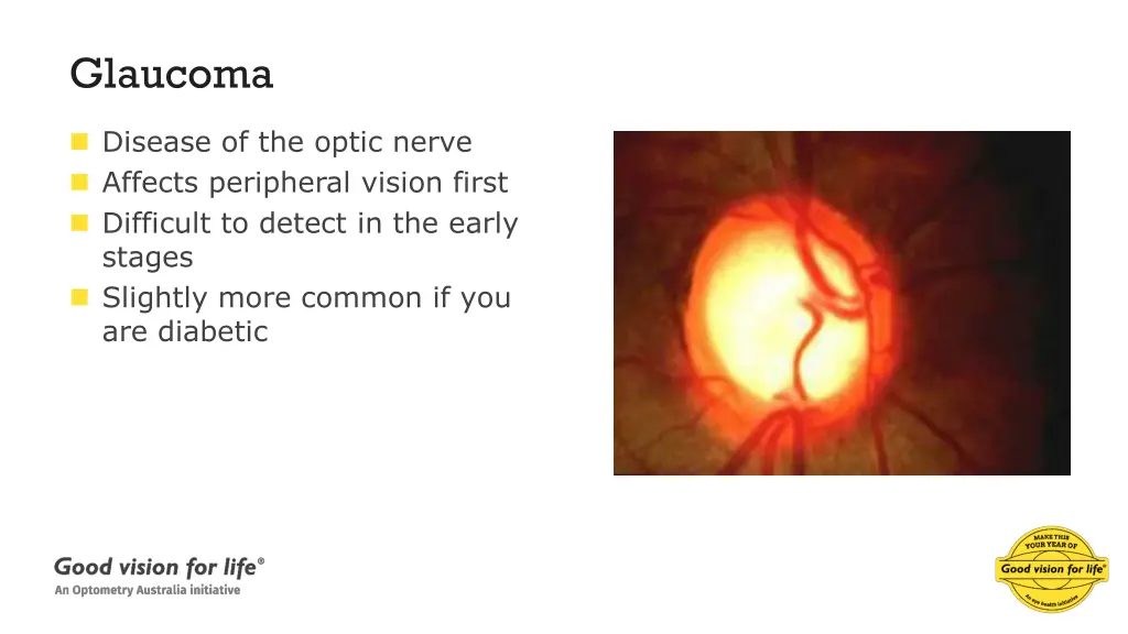 glaucoma