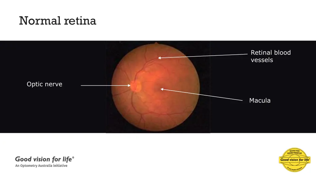 normal retina