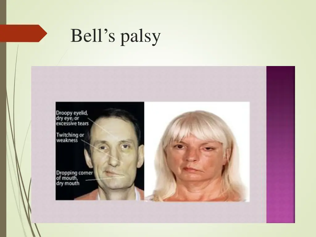 bell s palsy