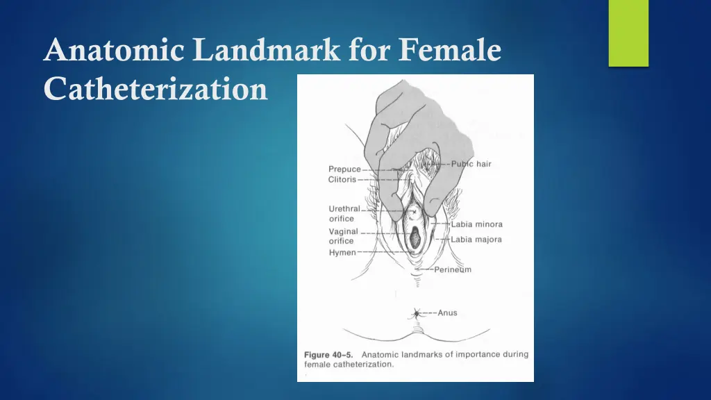 anatomic landmark for female catheterization