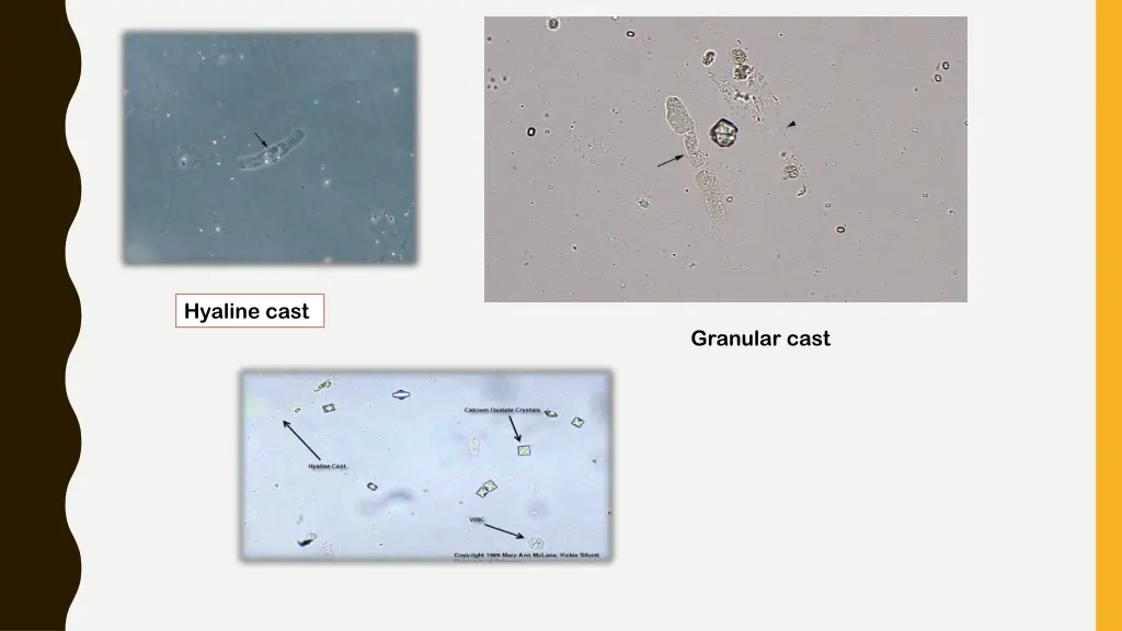 hyaline cast