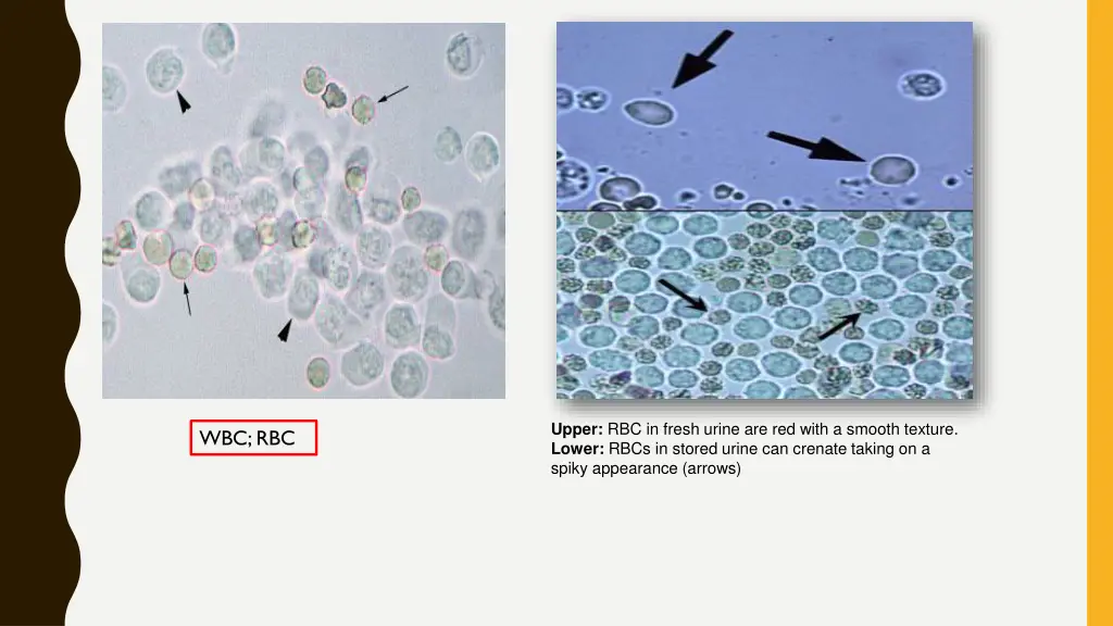 upper rbc in fresh urine are red with a smooth