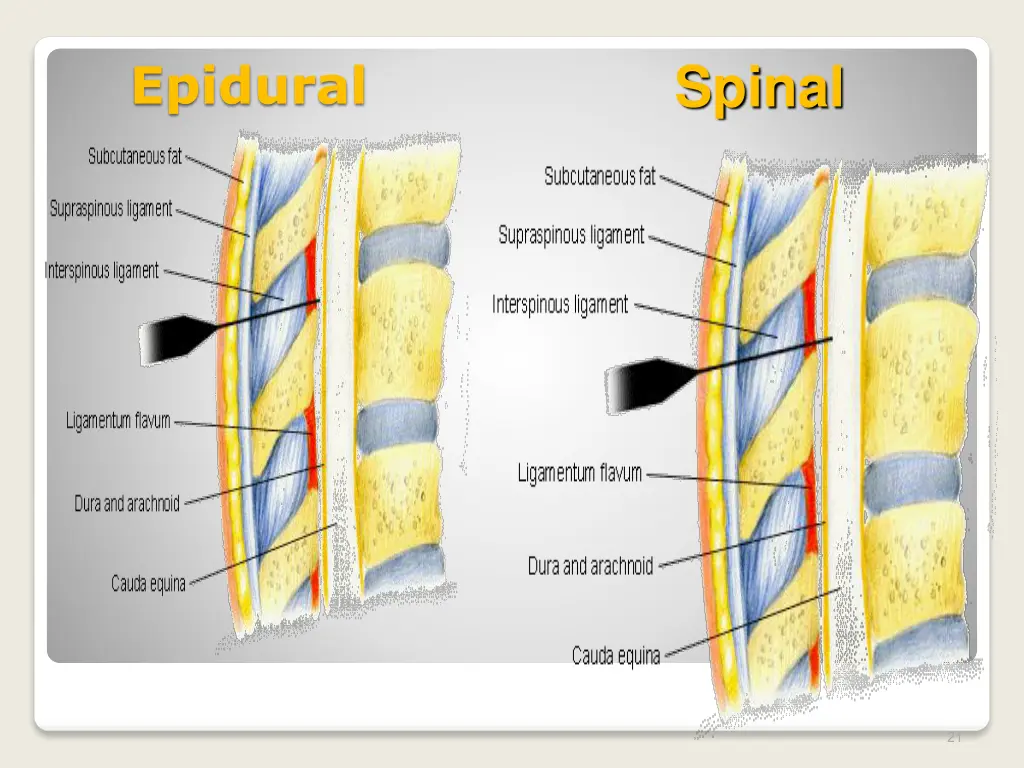 epidural