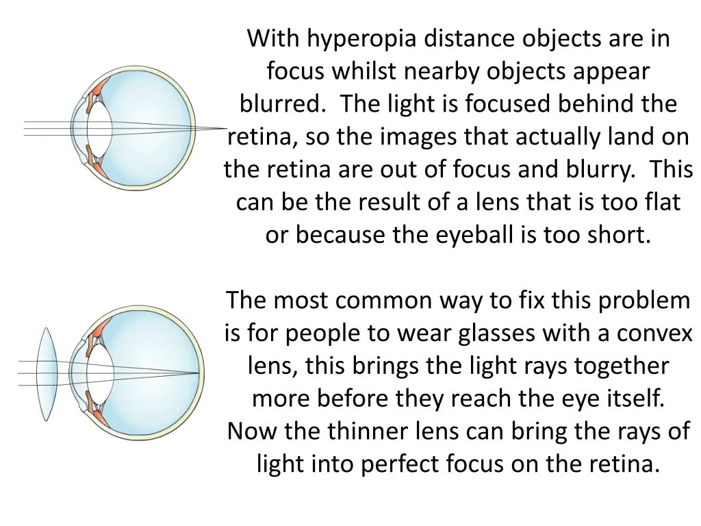 with hyperopia distance objects are in focus