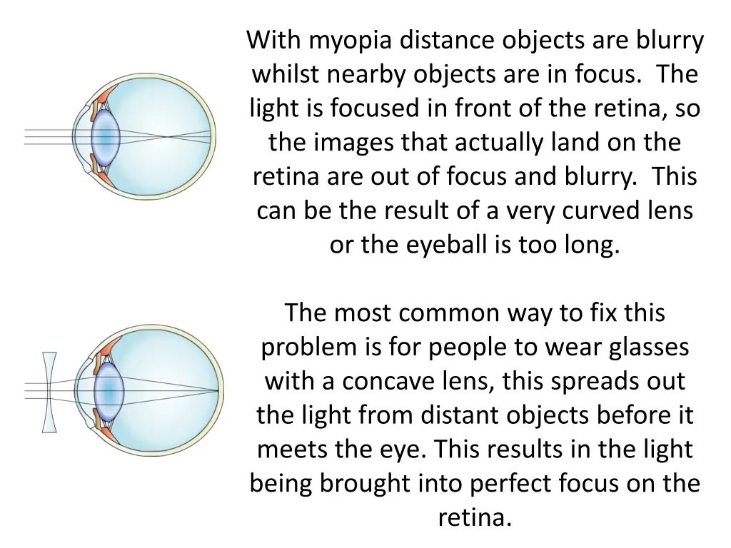 with myopia distance objects are blurry whilst