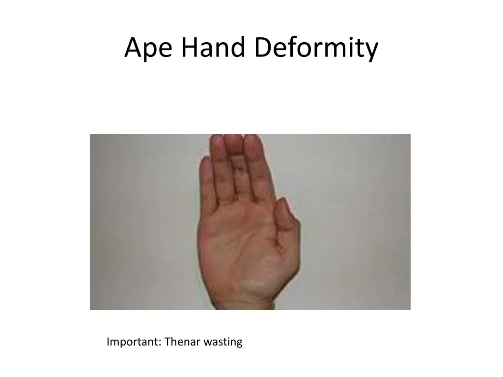 ape hand deformity