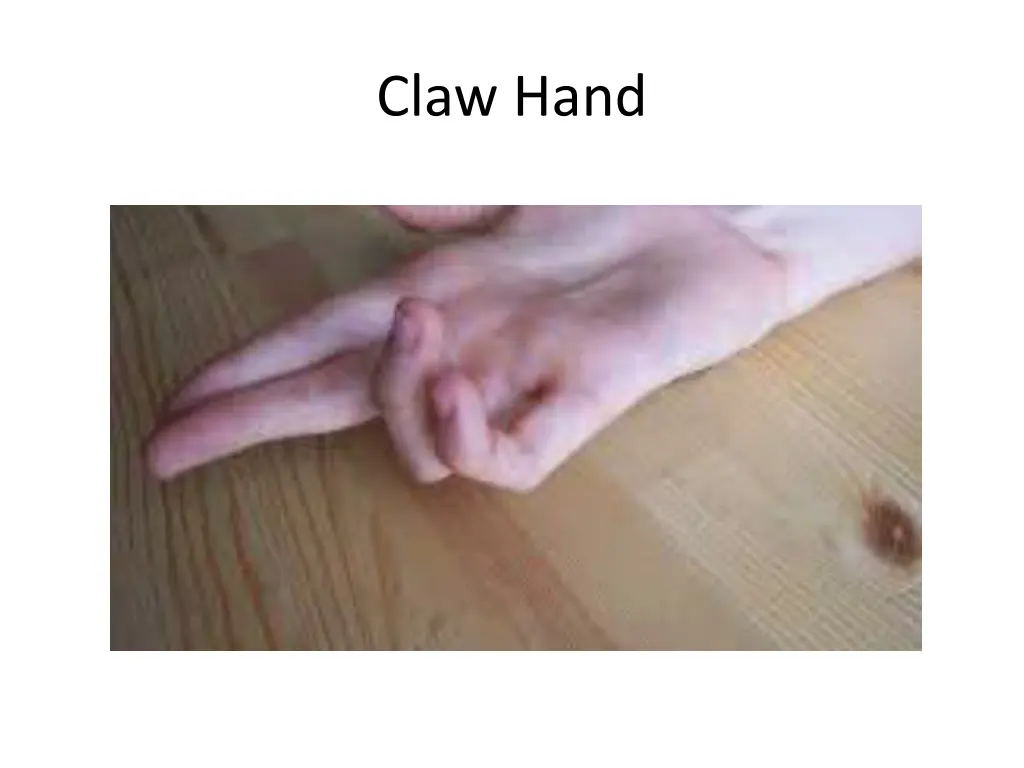 claw hand