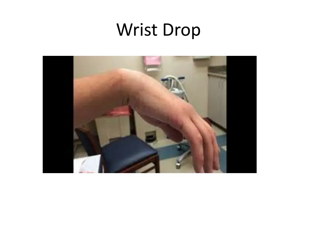 wrist drop