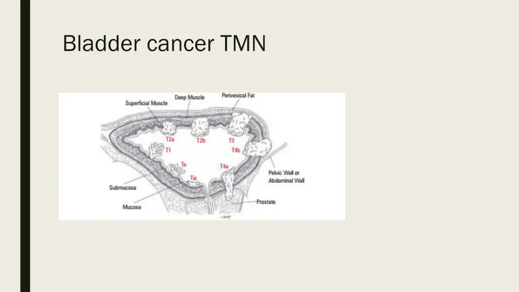 bladder cancer tmn