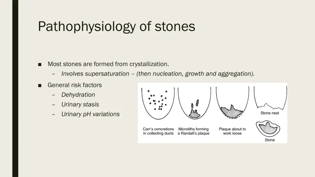 pathophysiology of stones