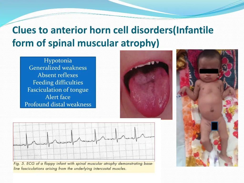 clues to anterior horn cell disorders infantile