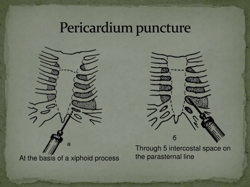 pericardiumpuncture