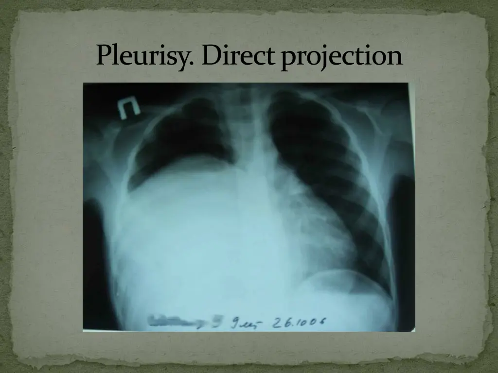 pleurisy directprojection