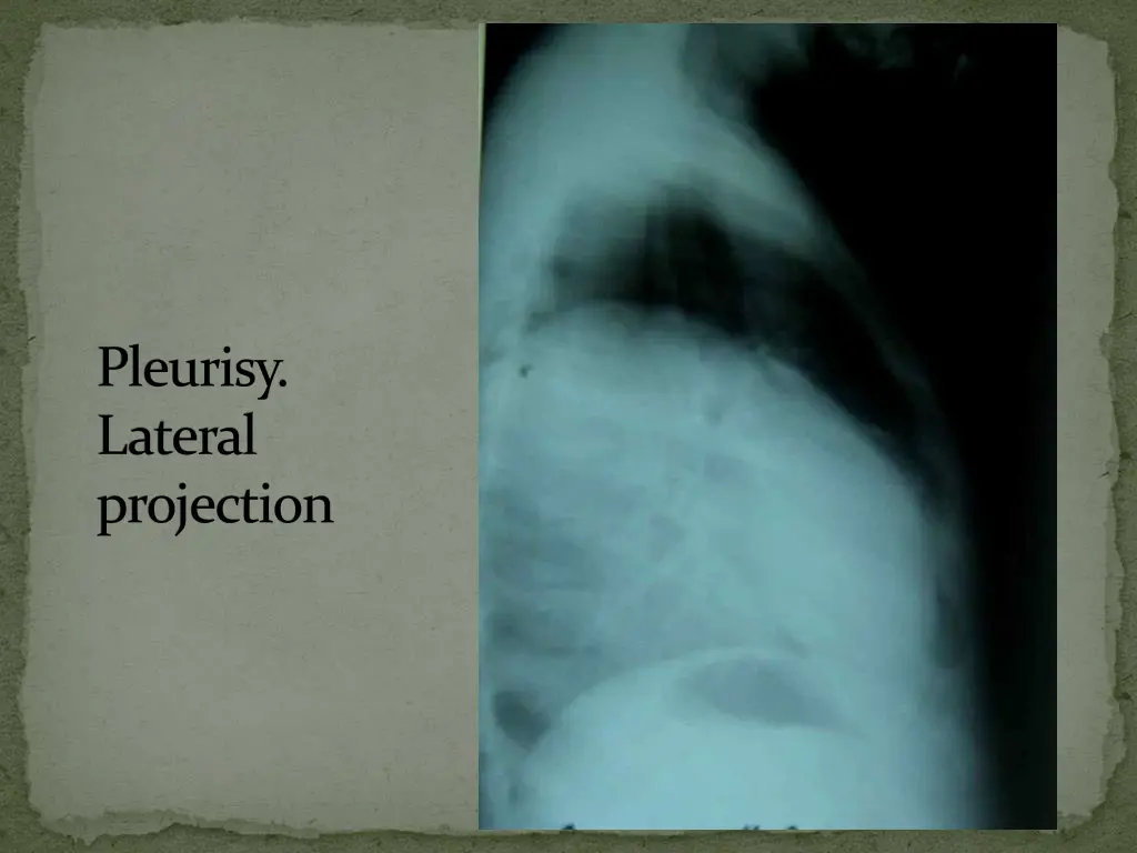 pleurisy lateral projection