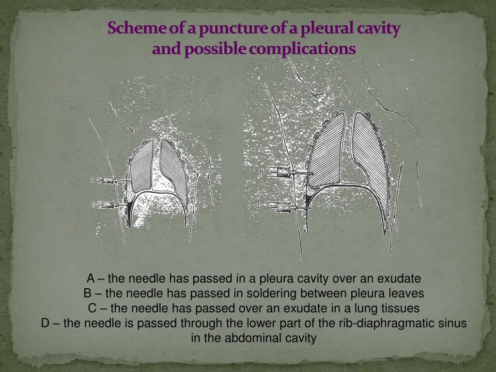 schemeofapunctureofapleuralcavity