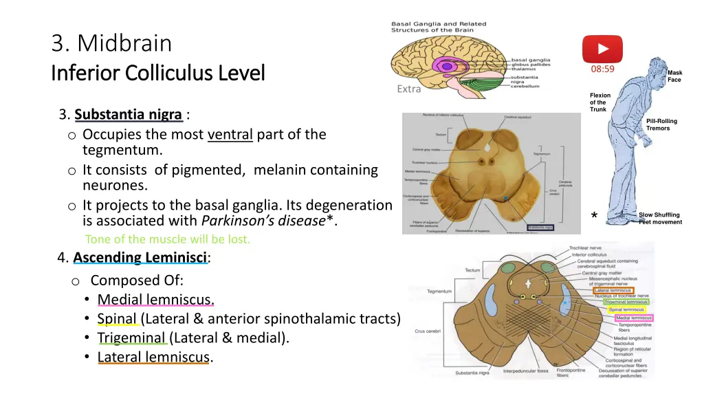 3 midbrain inferior colliculus level inferior 1