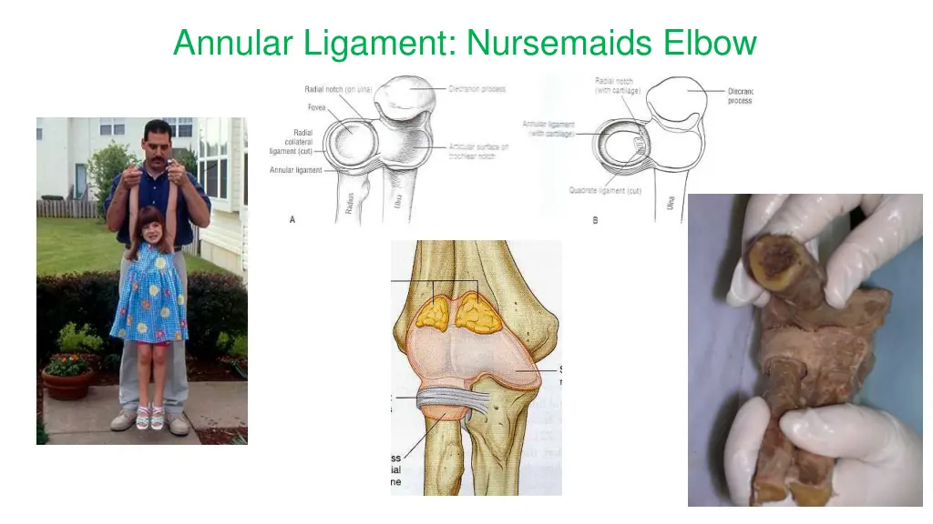 annular ligament nursemaids elbow