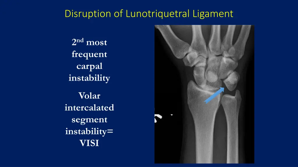 disruption of lunotriquetral ligament