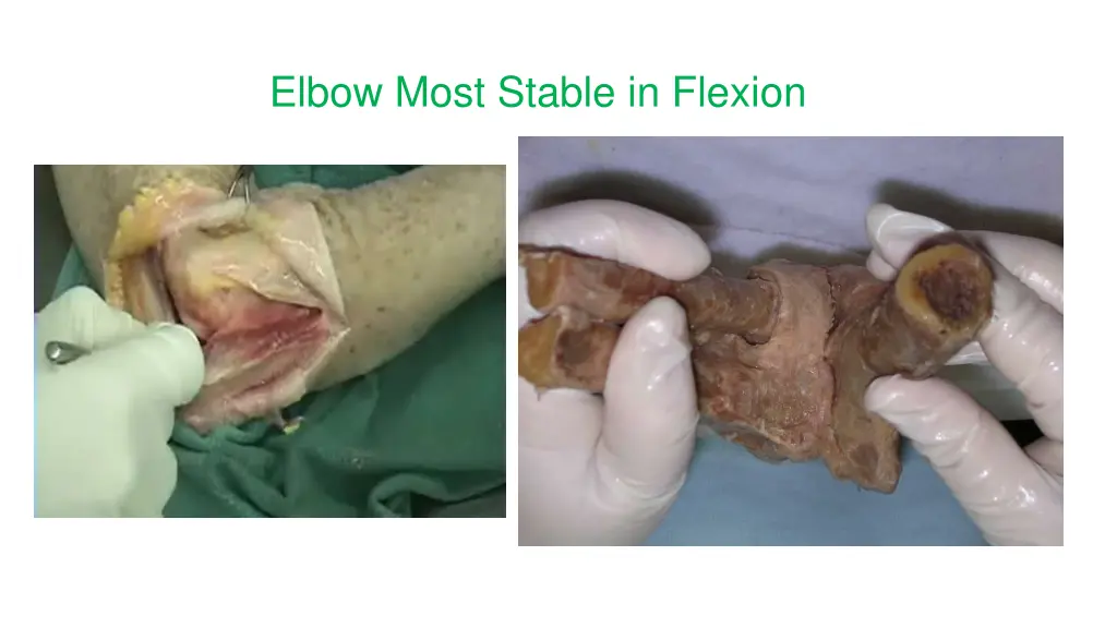 elbow most stable in flexion