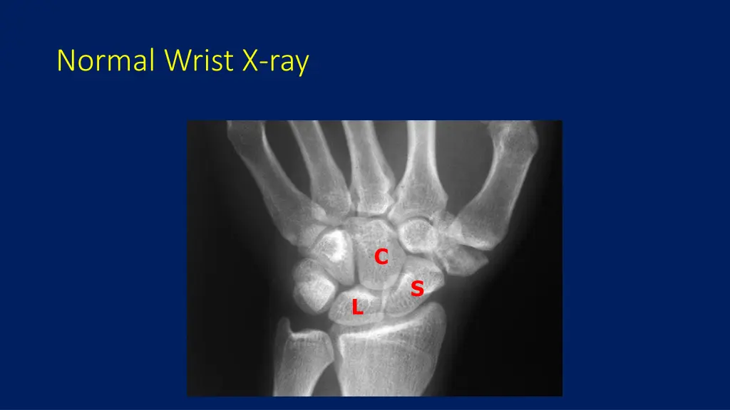 normal wrist x ray