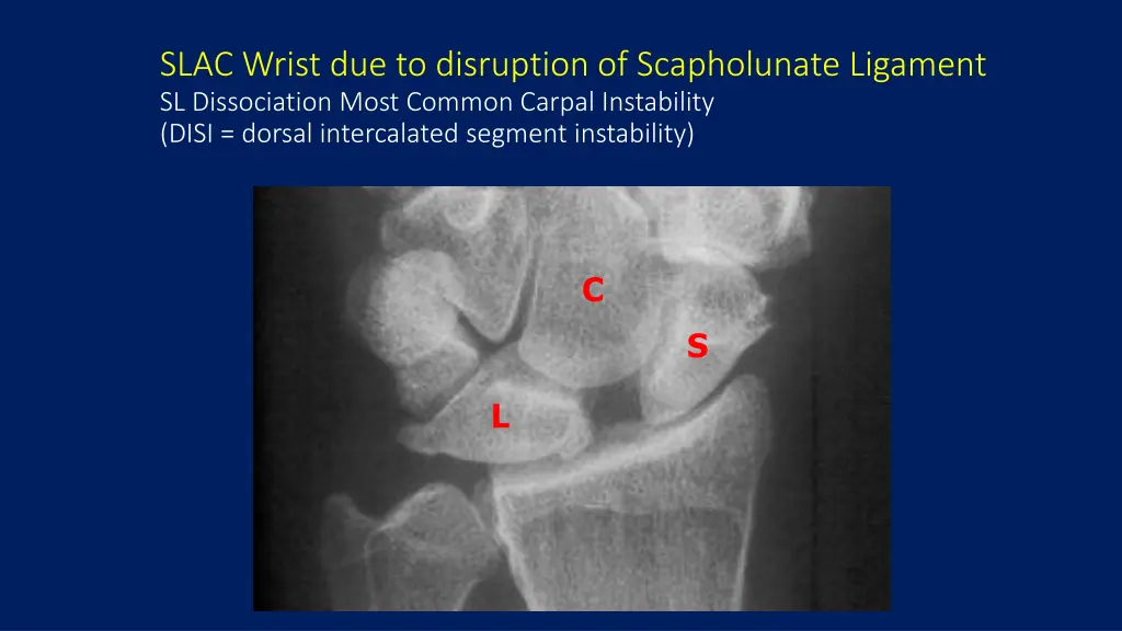 slac wrist due to disruption of scapholunate