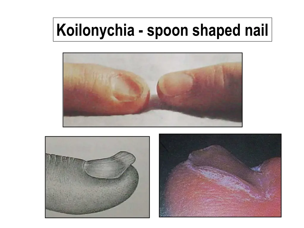 koilonychia spoon shaped nail