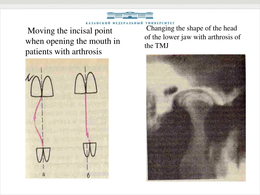 changing the shape of the head of the lower