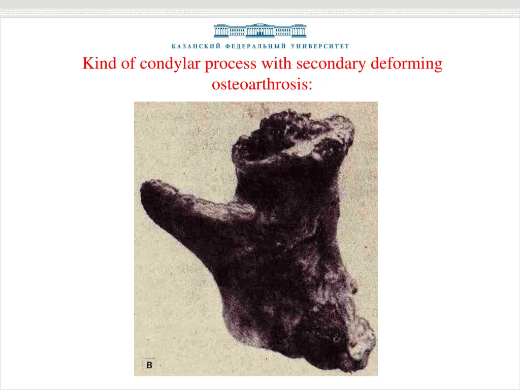 kind of condylar process with secondary deforming