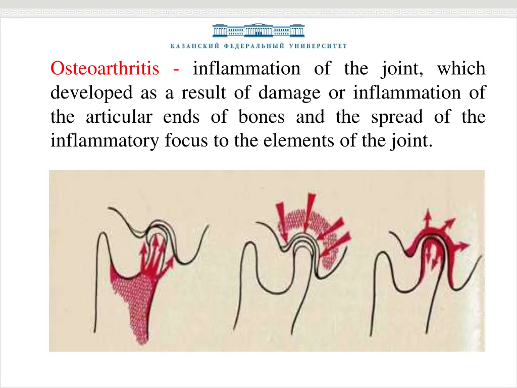 osteoarthritis inflammation of the joint which