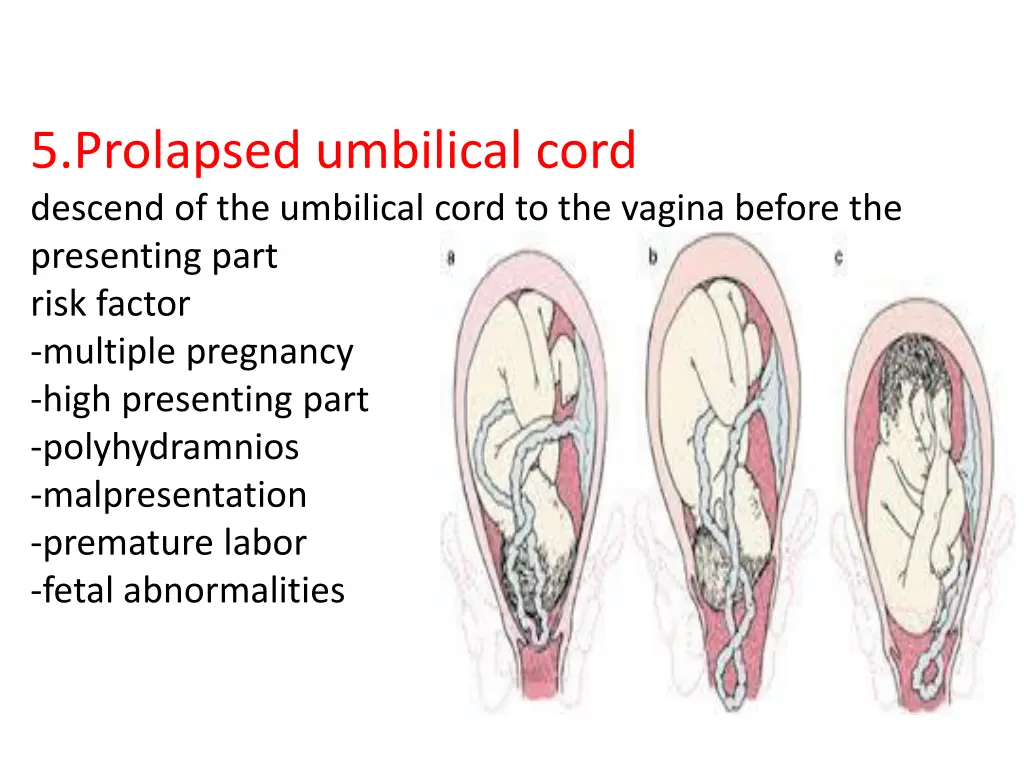 5 prolapsed umbilical cord descend