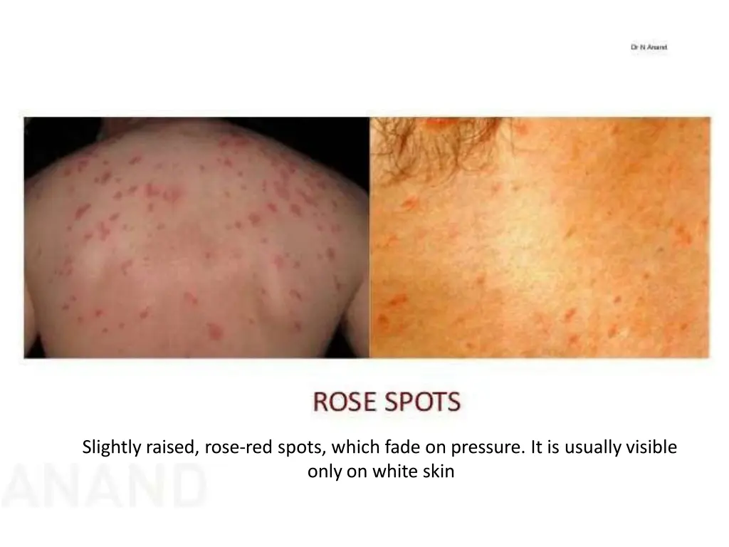 slightly raised rose red spots which fade