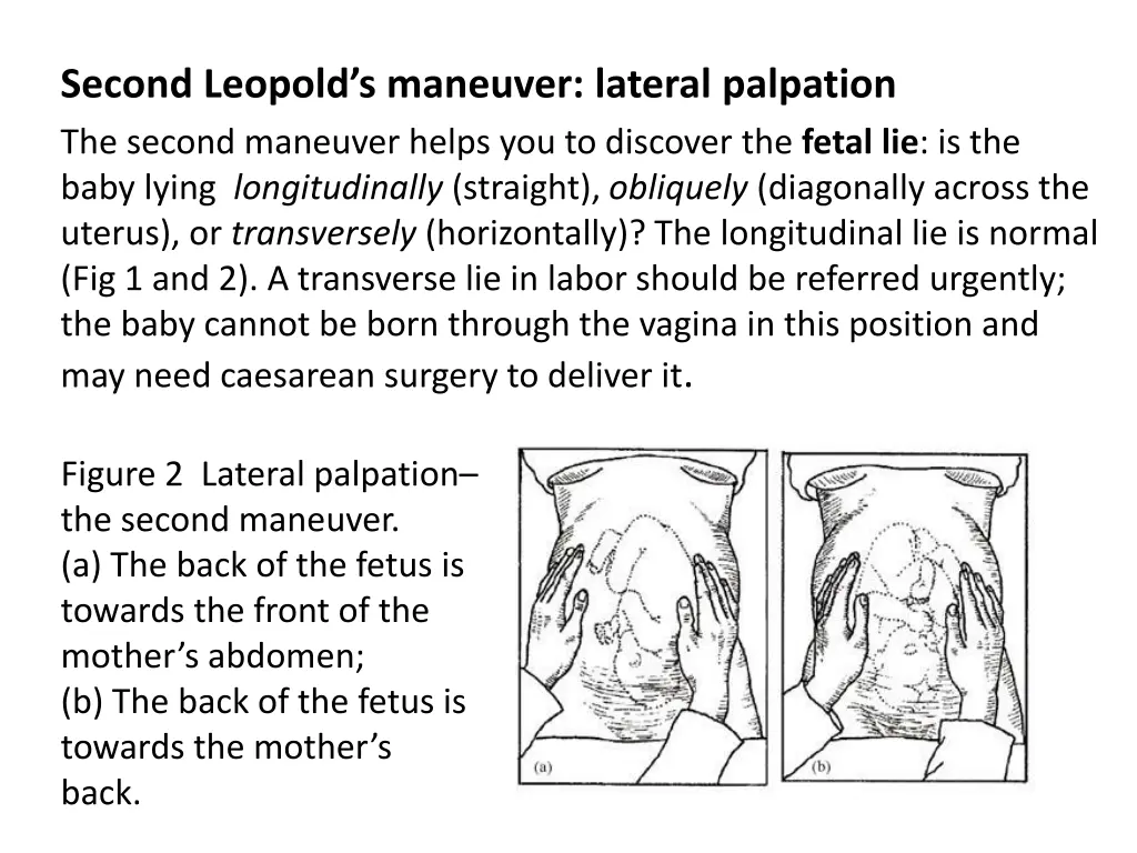 second leopold s maneuver lateral palpation