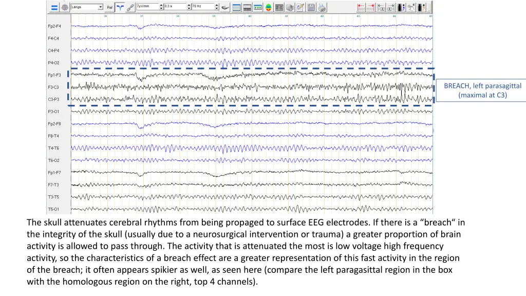 breach left parasagittal maximal at c3