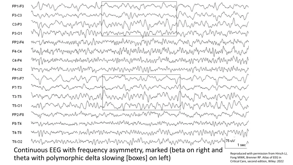 continuous eeg with frequency asymmetry marked