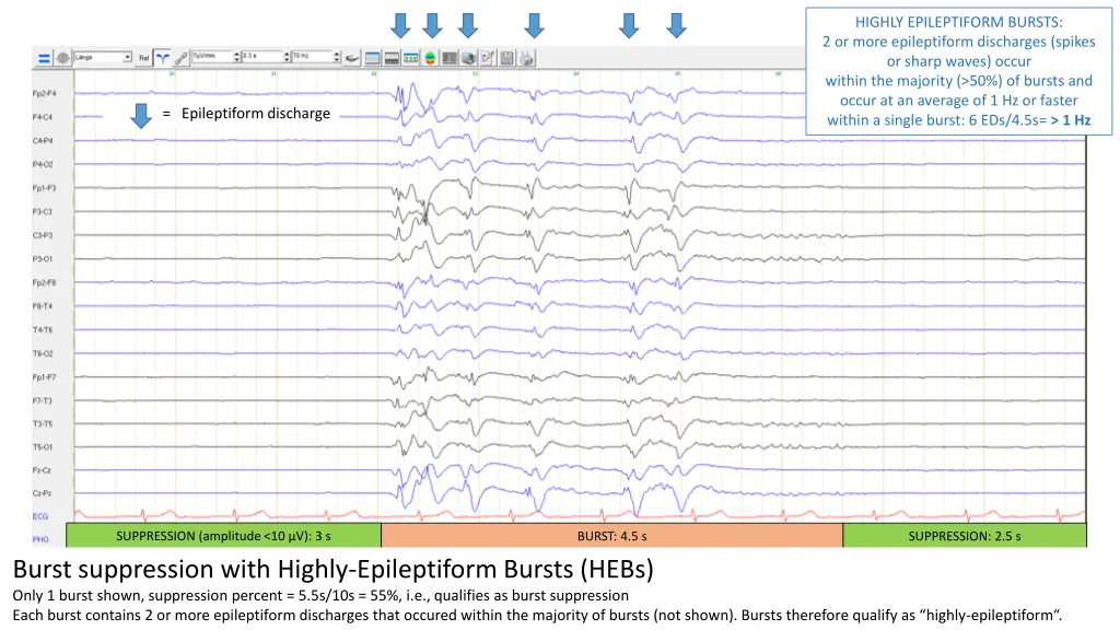 highly epileptiform bursts 2 or more epileptiform