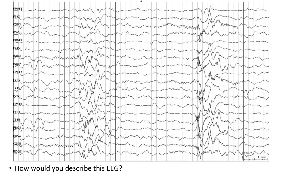 how would you describe this eeg