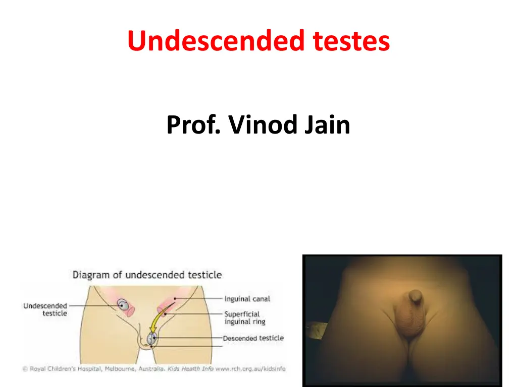 undescended testes