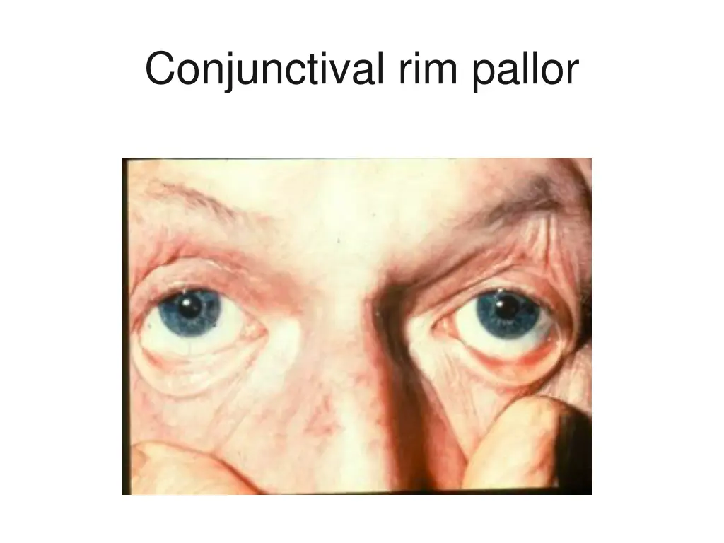 conjunctival rim pallor