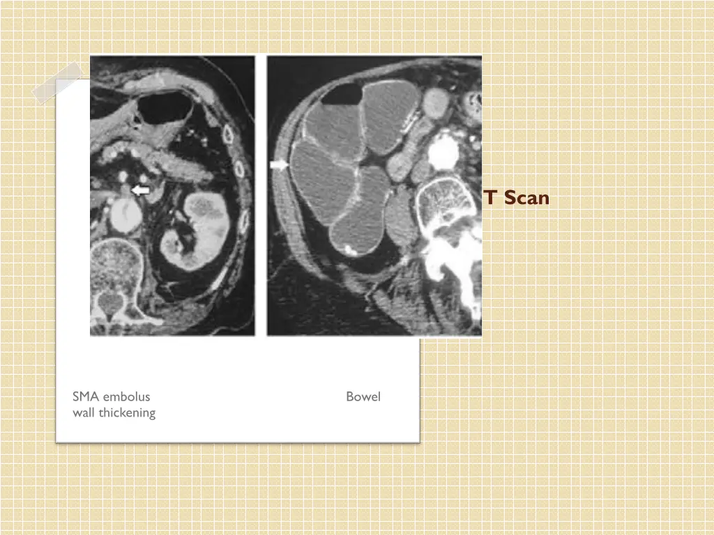 ct scan