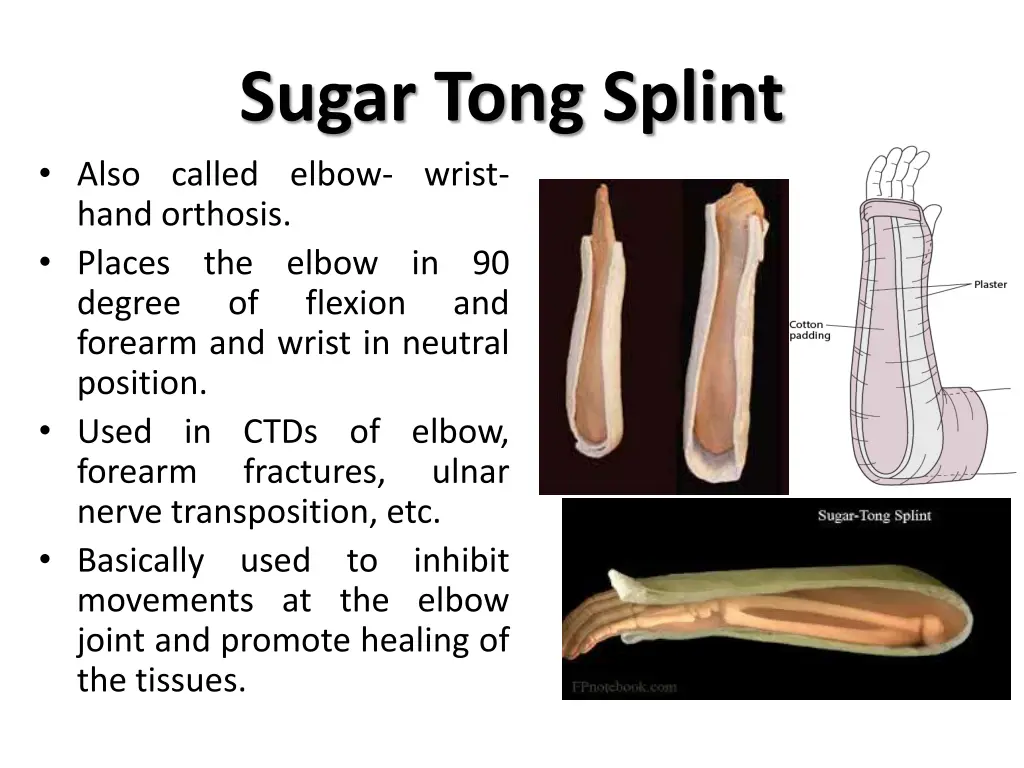 sugar tong splint also called elbow wrist hand