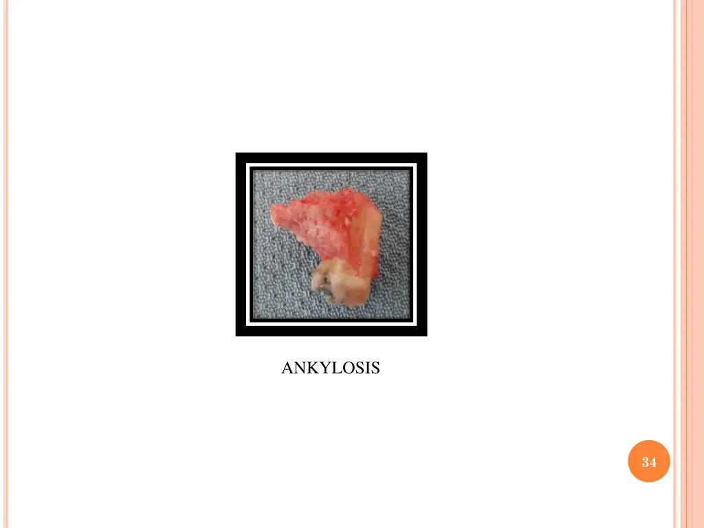 ankylosis 1