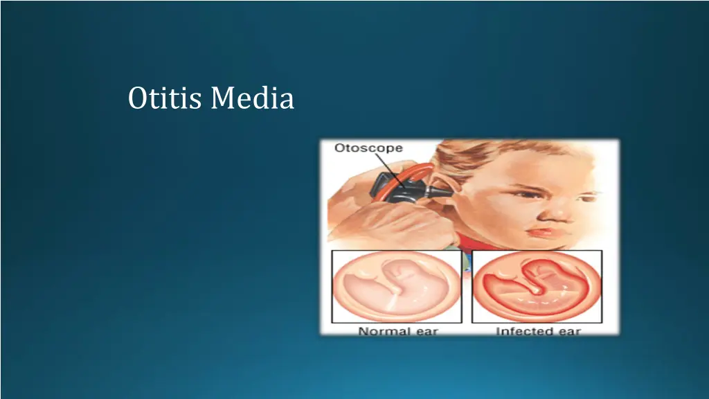 otitis media