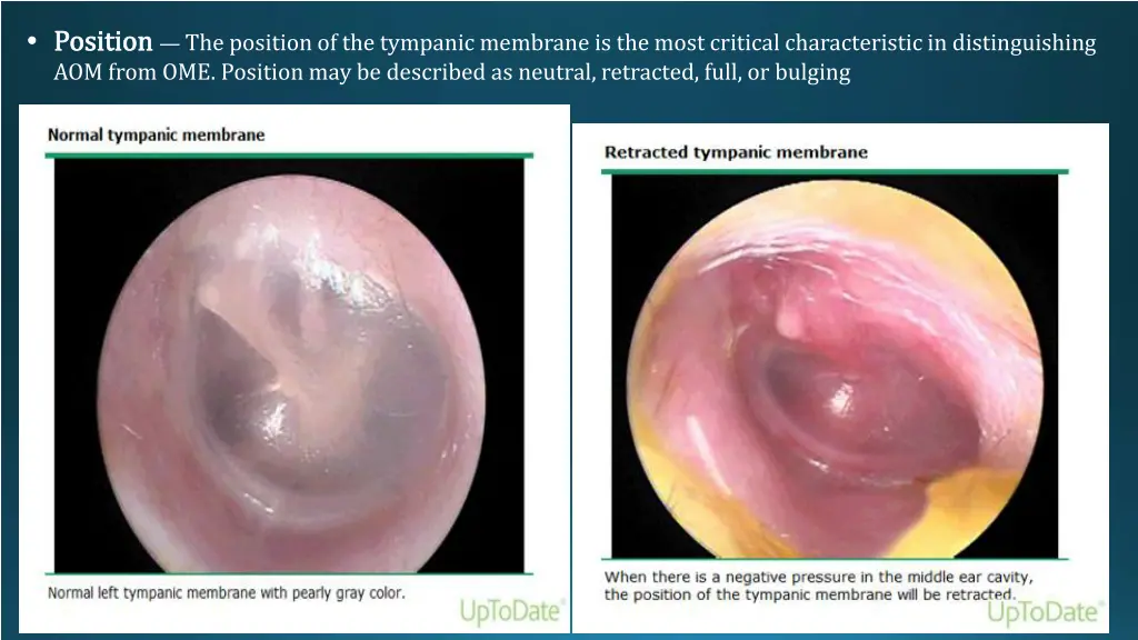 position the position of the tympanic membrane