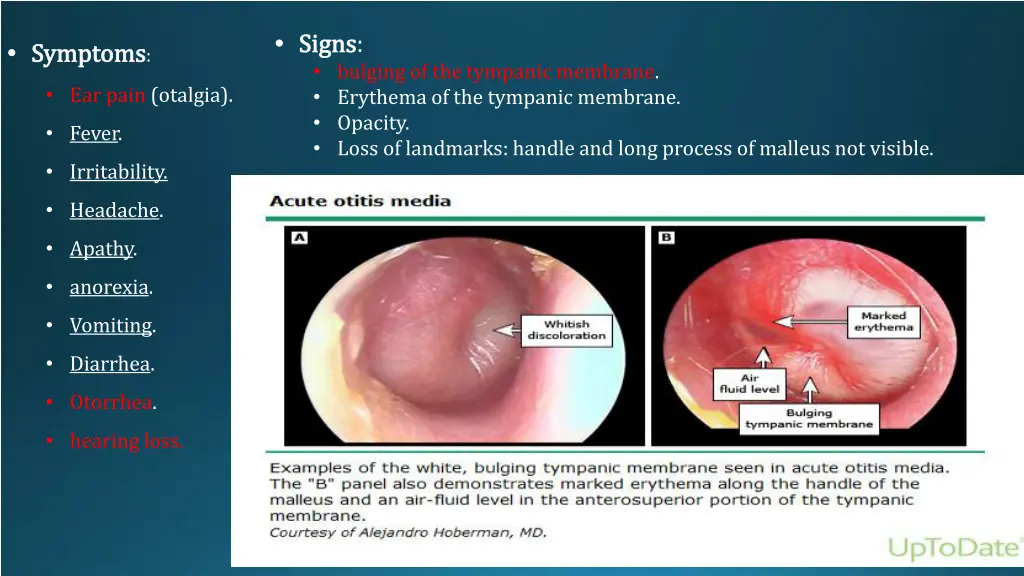 signs bulging of the tympanic membrane erythema