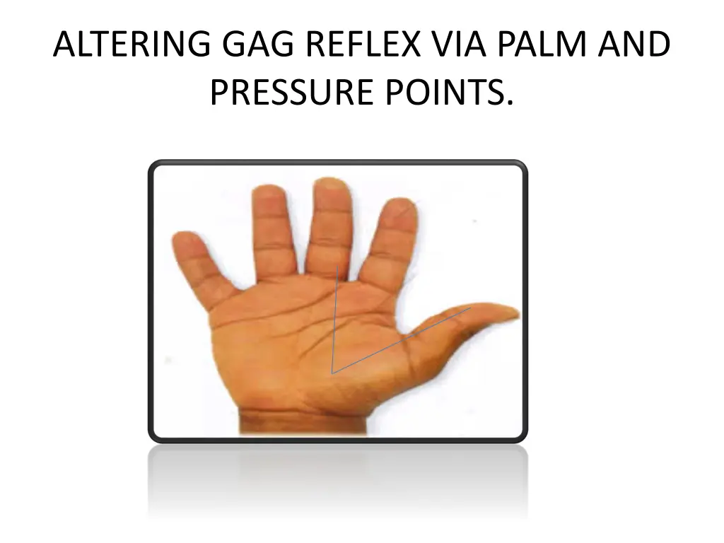 altering gag reflex via palm and pressure points