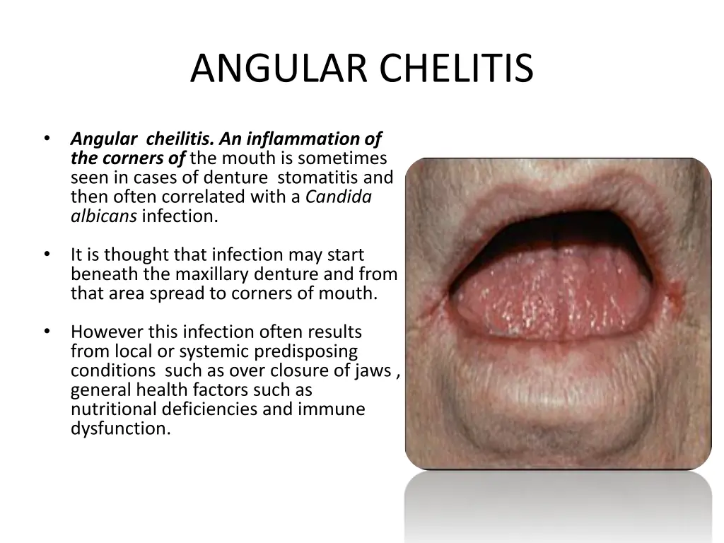 angular chelitis