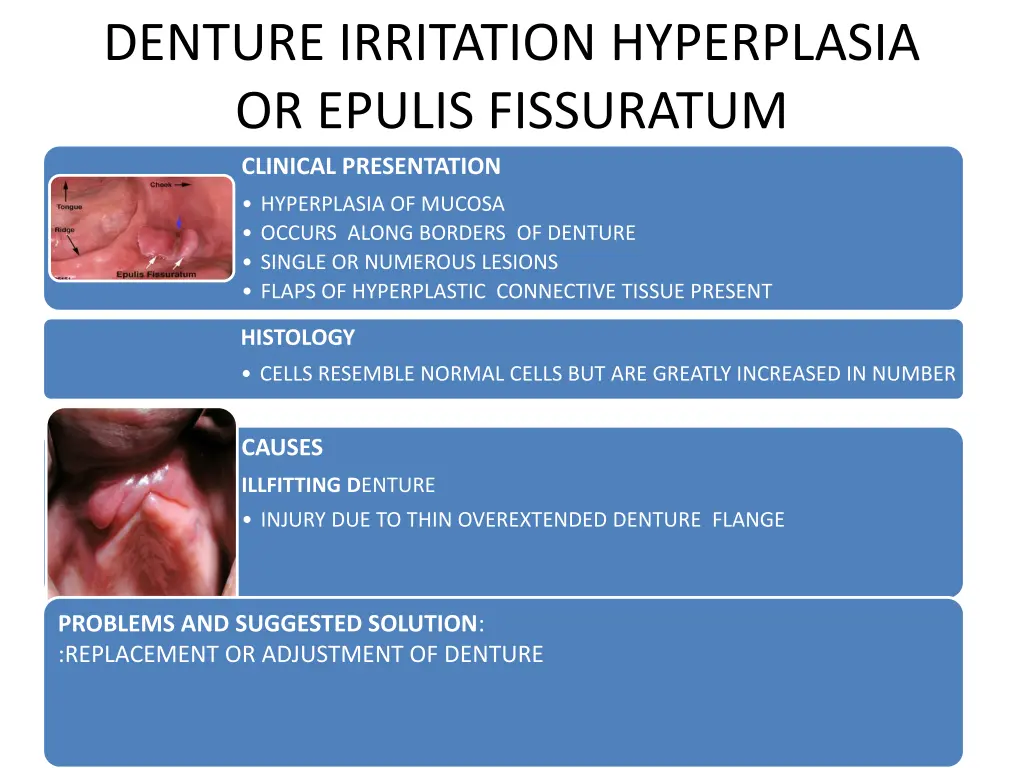 denture irritation hyperplasia or epulis