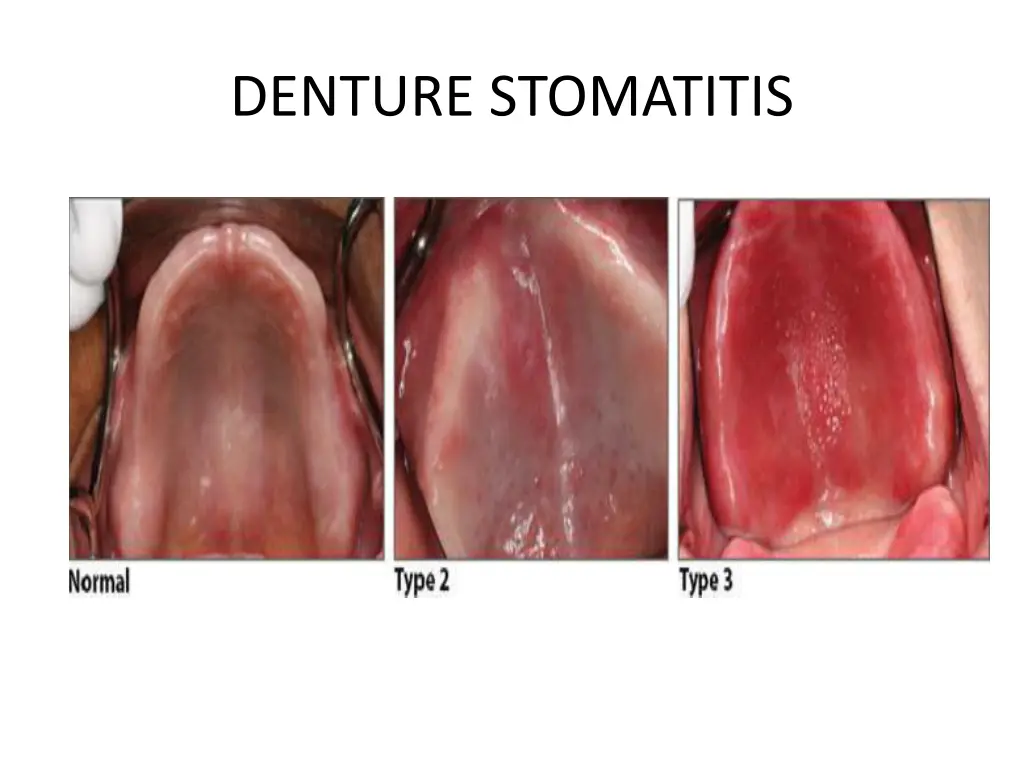 denture stomatitis 1