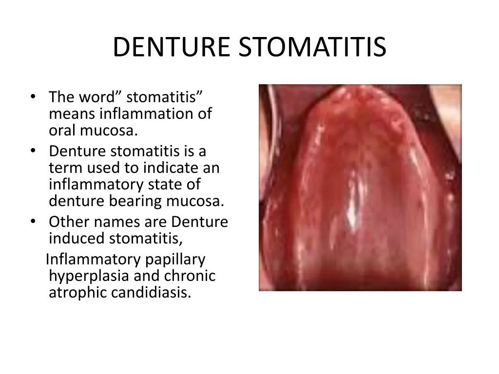 denture stomatitis