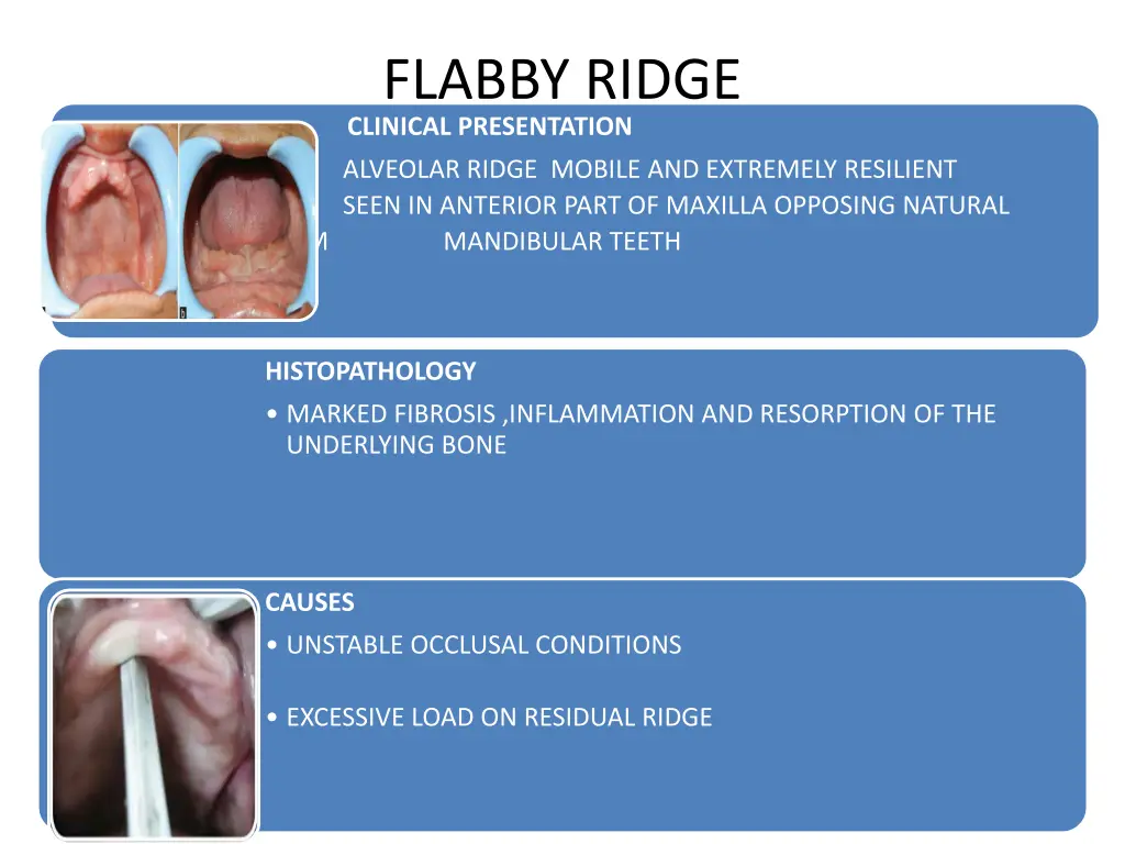 flabby ridge clinical presentation